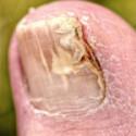 Fungal Toenails