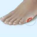 Diabetic Foot Care