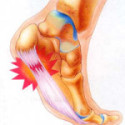 Plantar Fasciitis