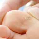 Plantar Warts